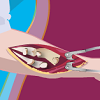 Elisa Arm Surgery  (Elisos rankos operacija)